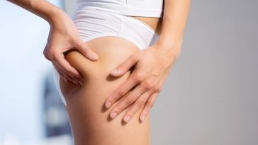 cellulite