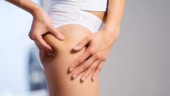 cellulite