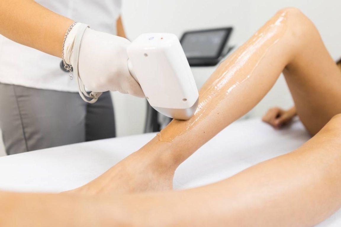 Épilation laser des jambes