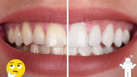 blanchiment dents methodes efficaces